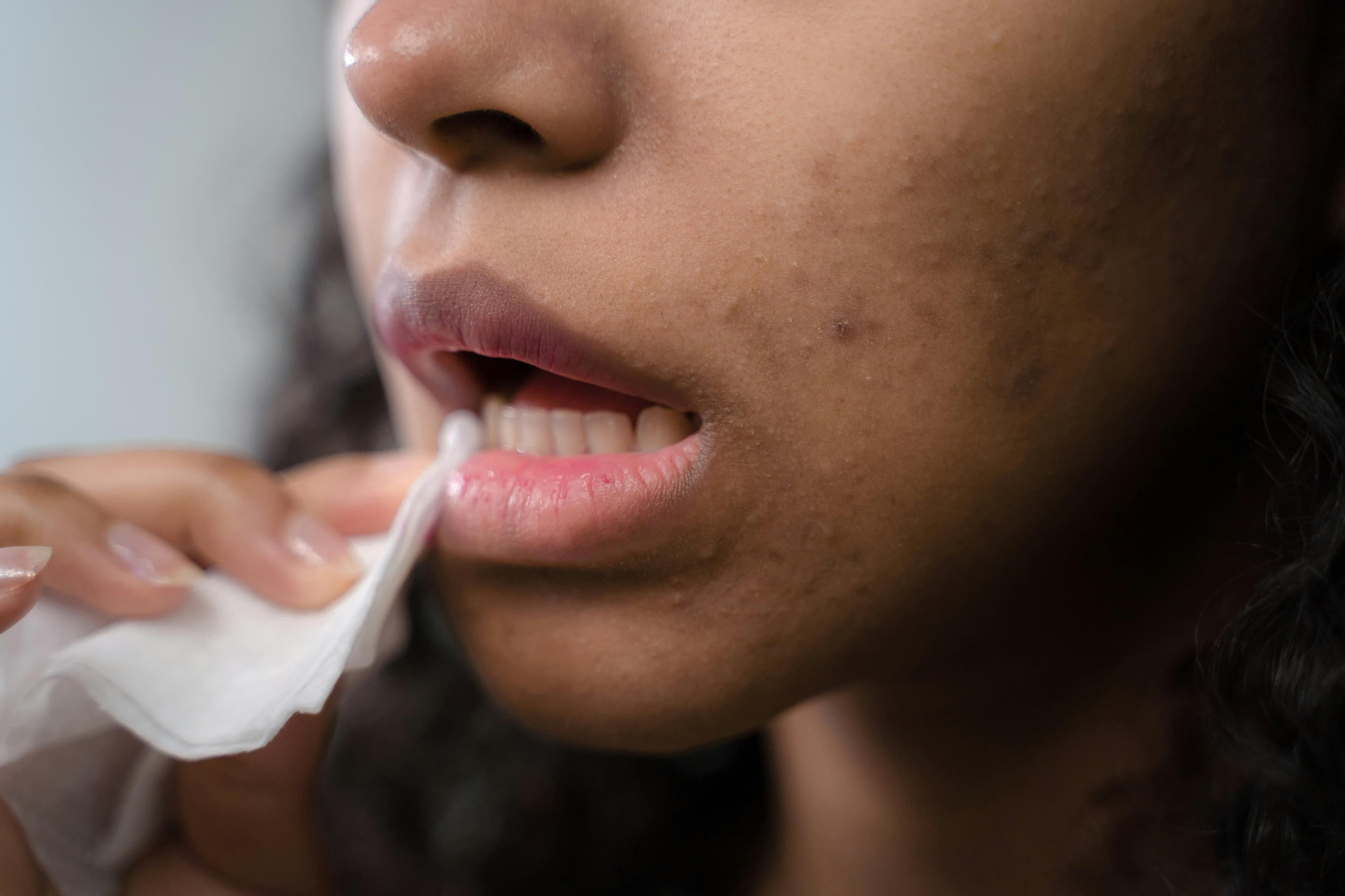 Acne in your 20s and 30s: hormonal vs bacterial, and how to tell